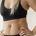 Técnica cirúrgica pode ser solução para diástase abdominal em Goiânia: Dr. David Santana comenta Técnica cirúrgica pode ser solução para diástase abdominal em Goiânia: Dr. David Santana comenta