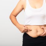 Abdominoplastia em âncora: procedimento indicado para grandes perdas de peso pode transformar a saúde física e emocional Abdominoplastia em âncora procedimento indicado para grandes perdas de peso pode transformar a saúde física e emocional