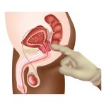 Dr. Marco Túlio Cruvinel, urologista em Goiânia, apresenta as etapas fundamentais para o diagnóstico preciso do câncer de próstata Dr. Marco Túlio Cruvinel, urologista em Goiânia, apresenta as etapas fundamentais para o diagnóstico preciso do câncer de próstata