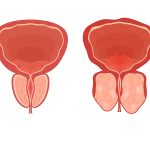 Cirurgias modernas para HPB avançam: conheça HoLEP e Rezum REZUM ou HoLEP Qual a melhor cirurgia para a hiperplasia prostática benigna (HPB)