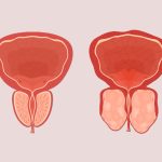 Enucleação prostática: cirurgia moderna com laser garante qualidade de vida aos homens Por que a enucleação prostática tem ganhado espaço como alternativa moderna para tratar o crescimento benigno da próstata