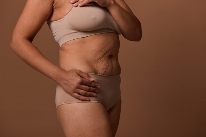 Quando a cicatriz da abdominoplastia vira símbolo de força