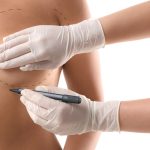 Recuperação menos dolorosa ganha espaço com técnicas que reduzem agressão ao corpo Ela achava que a recuperação seria um pesadelo