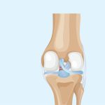 Trauma no joelho e dor intensa podem indicar lesão do LCP Lesão do LCP a lesão esquecida que pode deixar seu joelho instável