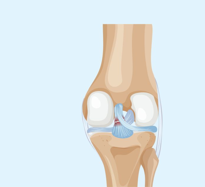 Lesão do LCP a lesão esquecida que pode deixar seu joelho instável