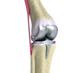 Prótese total de joelho pode devolver qualidade de vida Prótese total de joelho quando esse tratamento é indicado