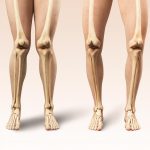 Alterações no alinhamento dos joelhos são mais comuns do que se imagina. Seus joelhos estão alinhados Veja o que o formato das suas pernas pode revelar