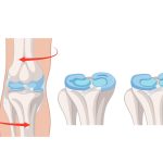 Nem toda lesão no menisco acontece de uma vez Dor, estalos e travamento no joelho Pode ser lesão no menisco