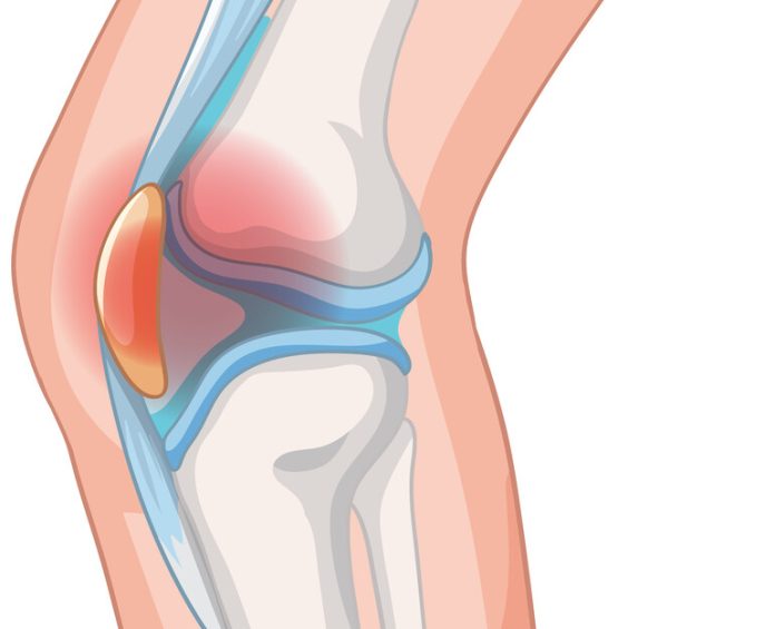 Dor na frente do joelho Pode ser condropatia patelar