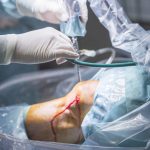 Preservação do menisco através da sutura Sutura do menisco quando ela é indicada