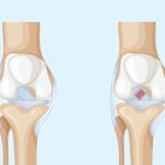 Lesão ligamentar no joelho afeta atletas e não atletas Lesão do LCA o problema que pode estar no seu joelho sem você saber