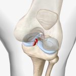 Lesão no menisco exige avaliação antes da decisão cirúrgica Lesionei o menisco É melhor reparar ou remover