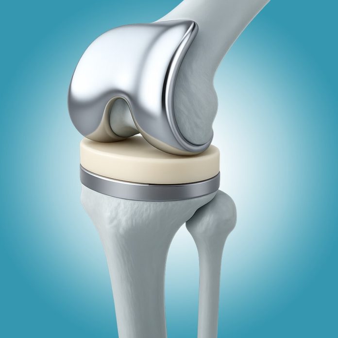 Os principais mitos sobre a prótese de joelho que ainda assustam pacientes